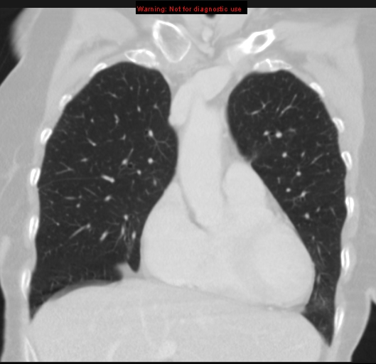 File:Bronchoalveolar carcinoma (BAC) (Radiopaedia 13436-13392 Coronal lung window 18).jpg
