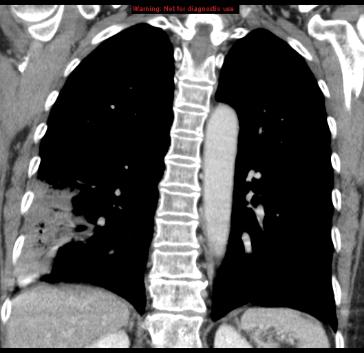 Bronchoalveolar carcinoma (BAC) (Radiopaedia 13436-13392 E 39).jpg