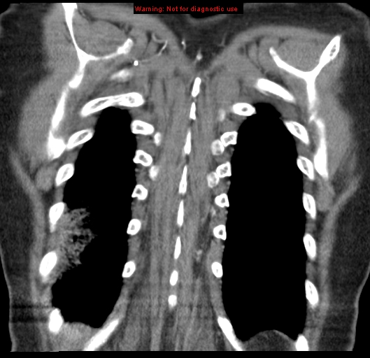 File:Bronchoalveolar carcinoma (BAC) (Radiopaedia 13436-13392 E 53).jpg