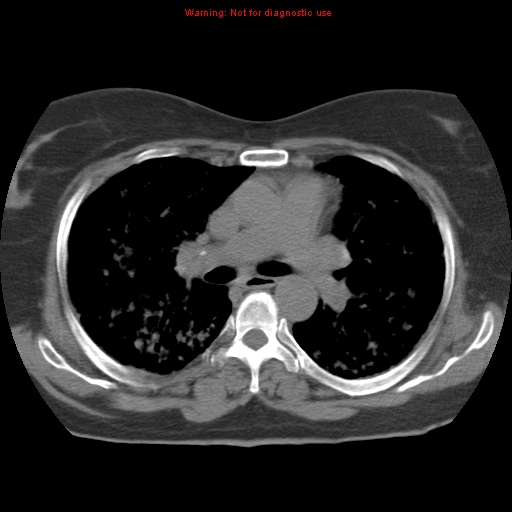 File:Bronchoalveolar carcinoma (Radiopaedia 13224-13233 Axial non-contrast 20).jpg