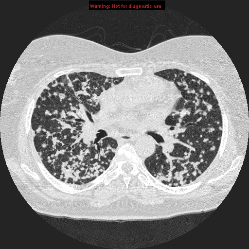 File:Bronchoalveolar carcinoma (Radiopaedia 13224-13233 B 5).jpg