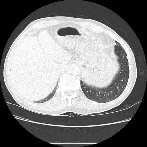 Bronchocele (Radiopaedia 17097-16795 Axial lung window 104).jpg