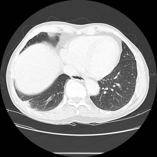 Bronchocele (Radiopaedia 17097-16795 Axial lung window 90).jpg