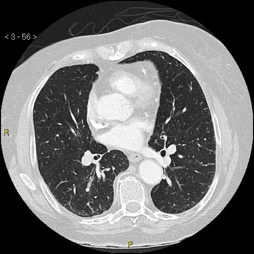 Bronchogenic carcinoma as an incidental finding (Radiopaedia 16453-16130 Axial lung window 56).jpg