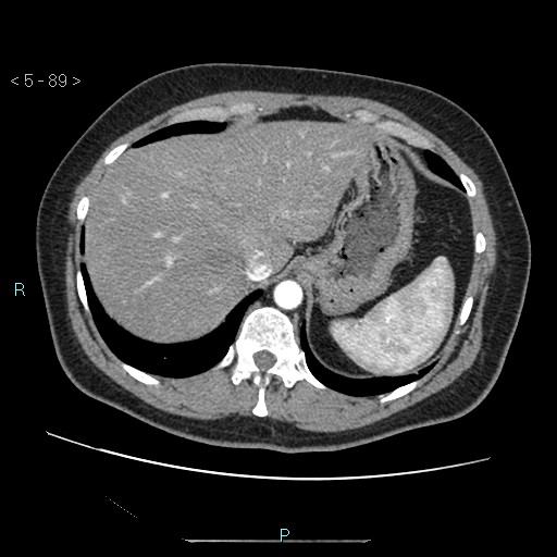 Bronchogenic cyst - posterior mediastinal (Radiopaedia 43885-47364 A 51).jpg
