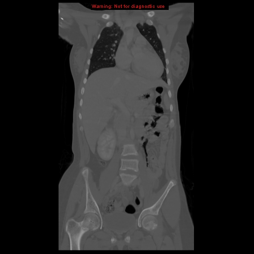 File:Brown tumor (Radiopaedia 12318-12596 D 30).jpg