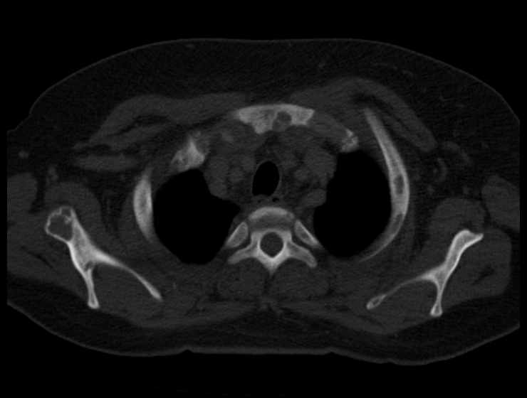 Brown tumors compressing the spinal cord (Radiopaedia 68442-77988 Axial bone window 11).jpg