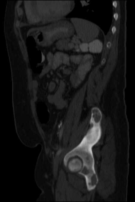 Brown tumors compressing the spinal cord (Radiopaedia 68442-77988 H 39).jpg
