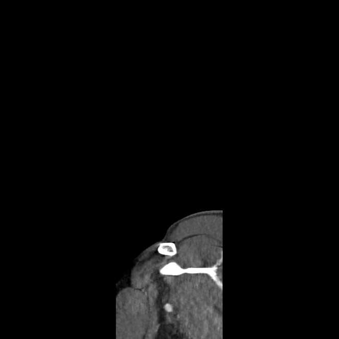 Buccal fat pad arteriovenous malformation (Radiopaedia 70936-81144 C 1).jpg