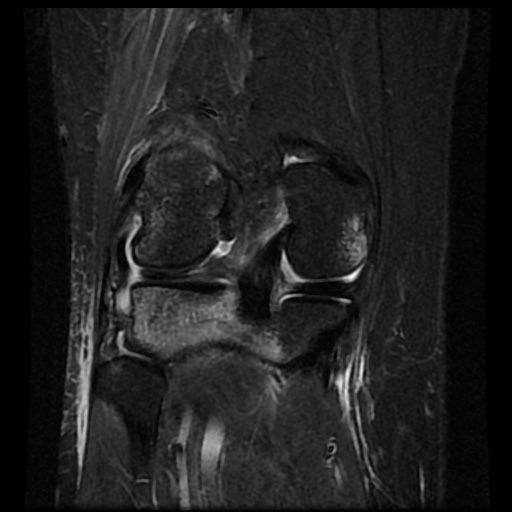 File:Bucket handle meniscus tear (Radiopaedia 56916-63751 Coronal STIR 14).jpg
