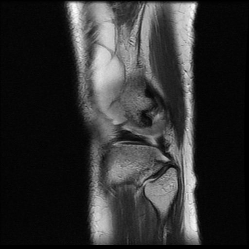 File:Bucket handle meniscus tear (Radiopaedia 56916-63751 Sagittal T2 3).jpg