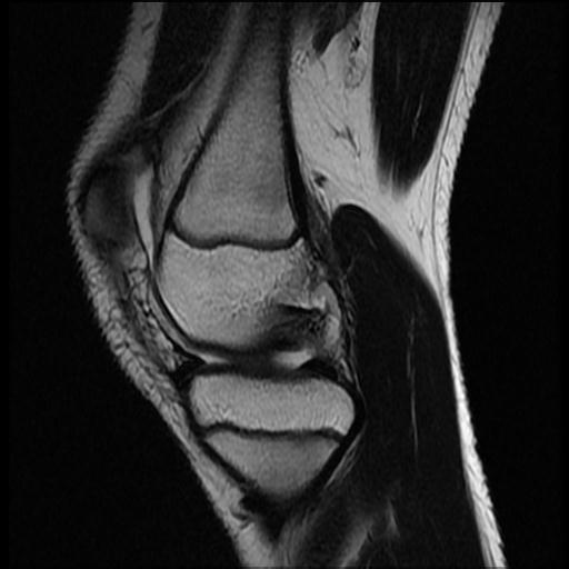 File:Bucket handle tear - lateral meniscus (Radiopaedia 72124-82634 Sagittal T2 11).jpg