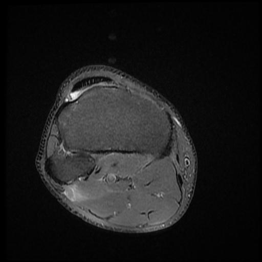 File:Bucket handle tear - medial meniscus (Radiopaedia 69245-79026 Axial PD fat sat 18).jpg