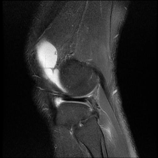 File:Bucket handle tear - medial meniscus (Radiopaedia 69245-79026 Sagittal PD fat sat 2).jpg