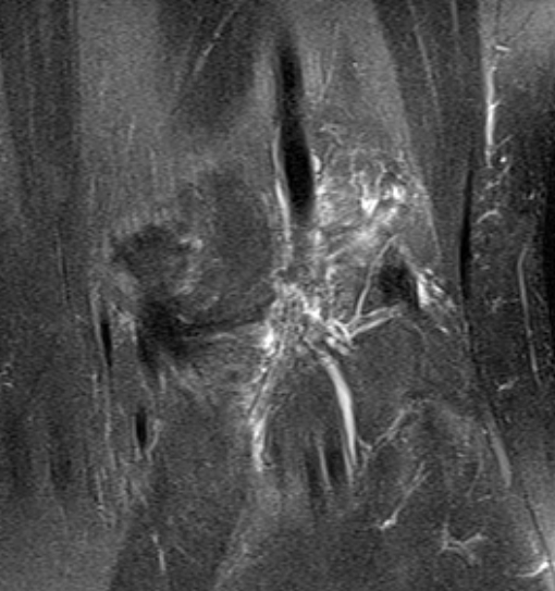 File:Bucket handle tear - medial meniscus (Radiopaedia 79028-91942 Coronal PD fat sat 1).jpg