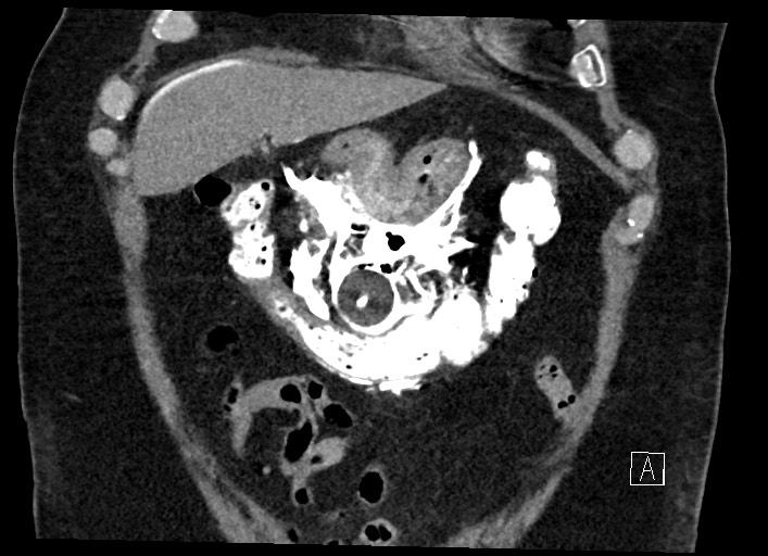 Buried bumper syndrome - gastrostomy tube (Radiopaedia 63843-72577 Coronal Inject 33).jpg