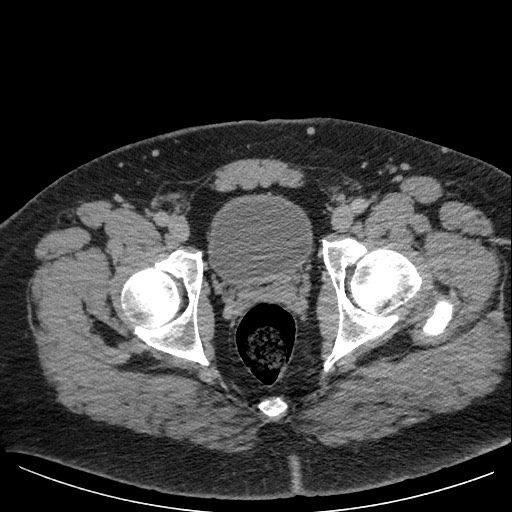 File:Burned-out testicular seminoma - retroperitoneal nodal metastases (Radiopaedia 62872-71245 A 68).jpg