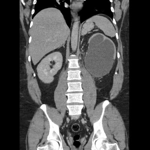 File:Burned-out testicular seminoma - retroperitoneal nodal metastases (Radiopaedia 62872-71245 B 43).jpg