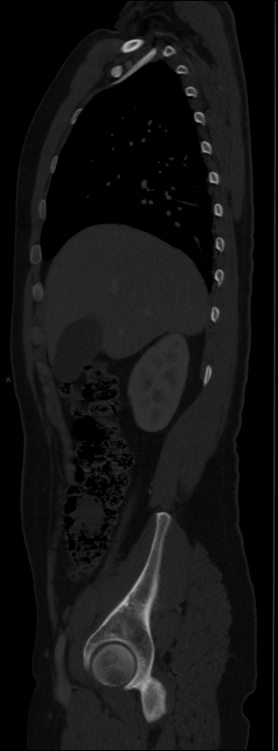 Burst fracture (Radiopaedia 83168-97542 Sagittal bone window 45).jpg