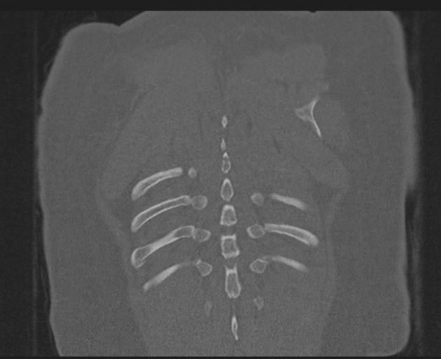 File:Burst fracture - thoracic spine (Radiopaedia 30238-30865 Coronal bone window 146).jpg