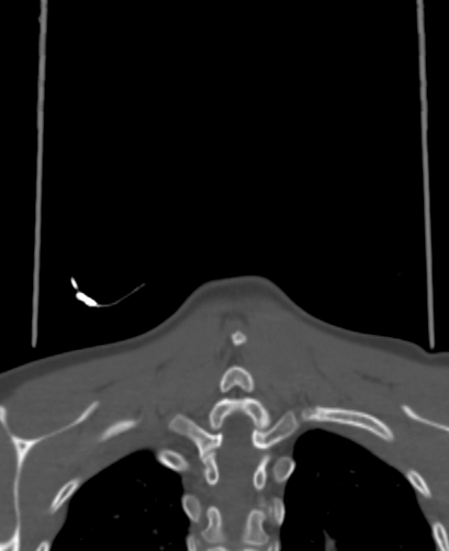 Butterfly vertebra (Radiopaedia 77903-90209 Coronal bone window 92).jpg