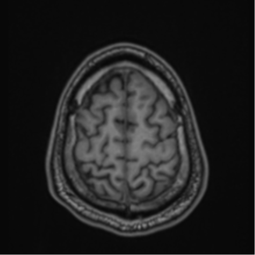 CNS vasculitis (Radiopaedia 55715-62263 Axial T1 87).png