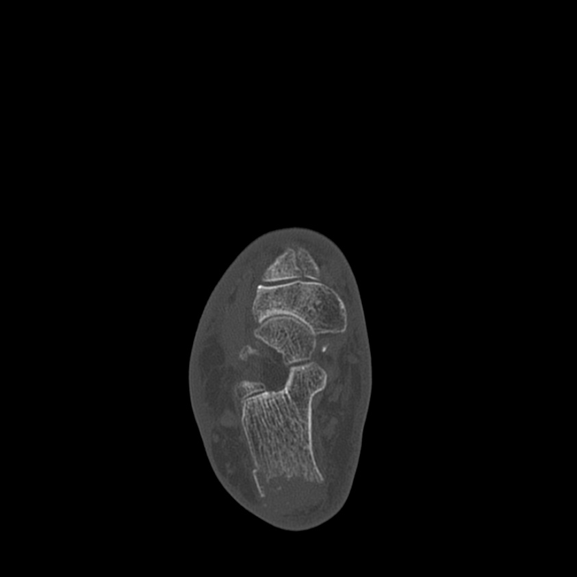 Calcaneal tuberosity avulsion fracture (Radiopaedia 22649-22668 Axial bone window 23).jpg