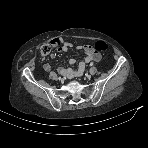 Calcified adrenal glands and Spigelian hernia (Radiopaedia 49741-54988 A 171).jpg