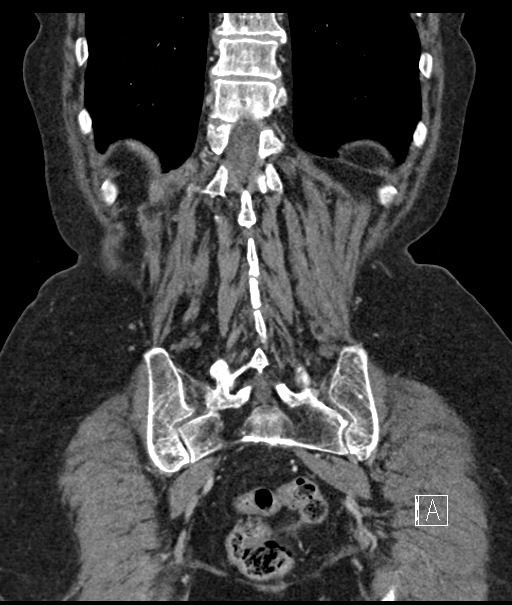 Calcified adrenal glands and Spigelian hernia (Radiopaedia 49741-54988 B 96).jpg