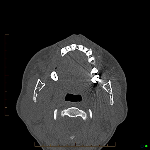 Calcified facial augmentation fillers (Radiopaedia 79514-92679 Axial bone window 89).jpg