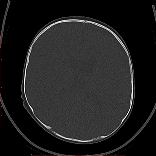 Calcified middle cerebral artery embolism (Radiopaedia 78949-91860 Axial bone window 39).jpg