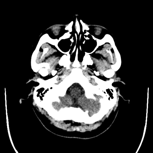 Calvarial osteoma (Radiopaedia 36520-38079 Axial non-contrast 8).jpg
