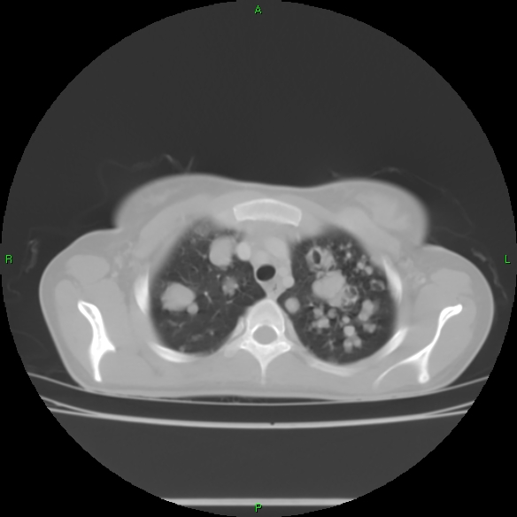 File:Cannon ball metastases - synovial sarcoma (Radiopaedia 26135-26271 Axial lung window 8).jpg
