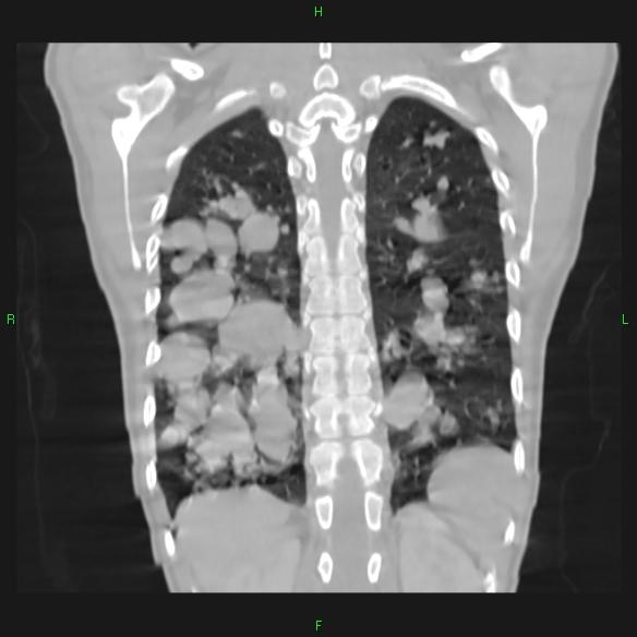 File:Cannon ball metastases - synovial sarcoma (Radiopaedia 26135-26271 Coronal lung window 17).jpg