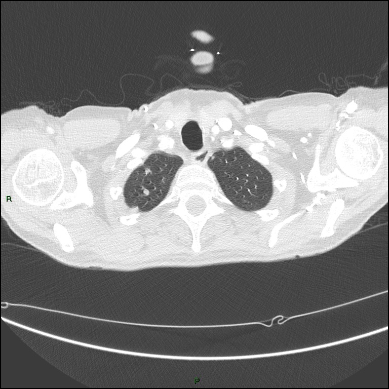 Cannonball metastases (Radiopaedia 82110-96150 Axial lung window 27).jpg