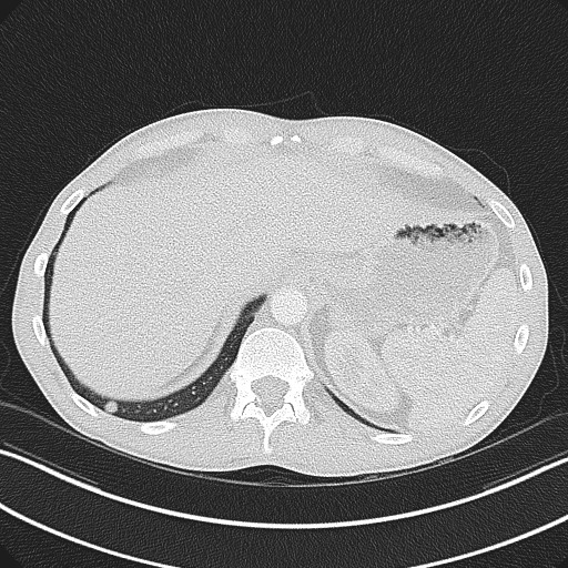 Cannonball metastases - testicular choriocarcinoma (Radiopaedia 84510-99891 Axial lung window 86).jpg