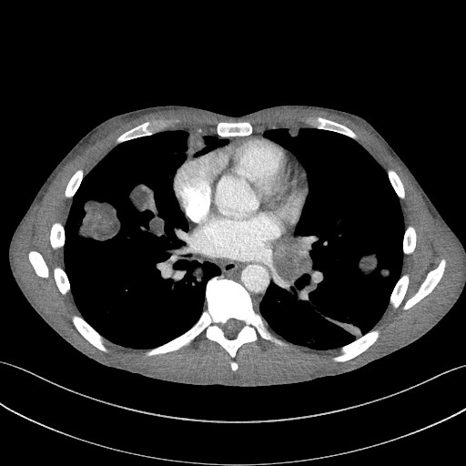 Cannonball metastases - testicular choriocarcinoma (Radiopaedia 84510-99891 B 65).jpg