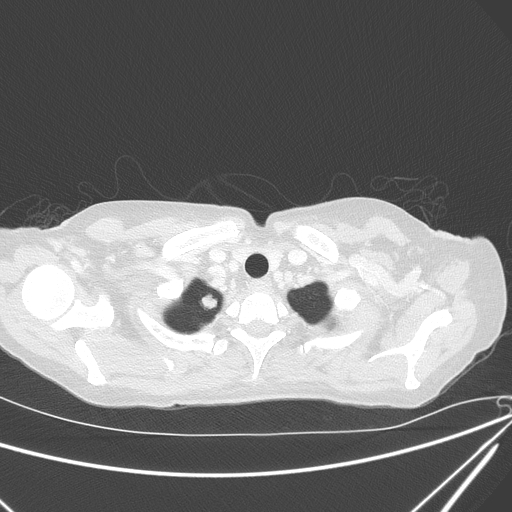 Canonball lung metastasis (Radiopaedia 77634-89837 Axial lung window 16).jpg