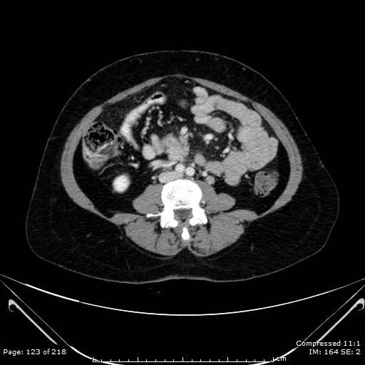 Carcinoid syndrome (Radiopaedia 52706-58626 A 62).jpg
