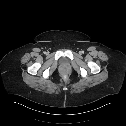 Carcinoid tumor - terminal ileum (Radiopaedia 60931-68739 A 137).jpg