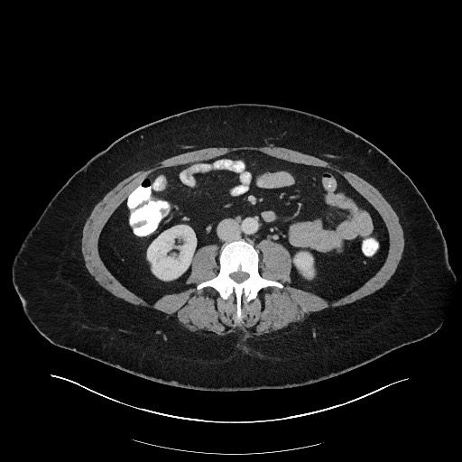 Carcinoid tumor - terminal ileum (Radiopaedia 60931-68739 A 71).jpg
