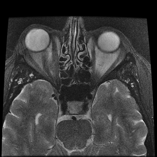 File:Carcinoid tumor of the ileum with metastasis to orbit (Radiopaedia 28165-28424 Axial T2 8).jpg