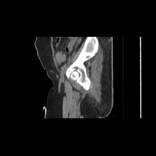 Carcinoma cervix- brachytherapy applicator (Radiopaedia 33135-34173 D 21).jpg