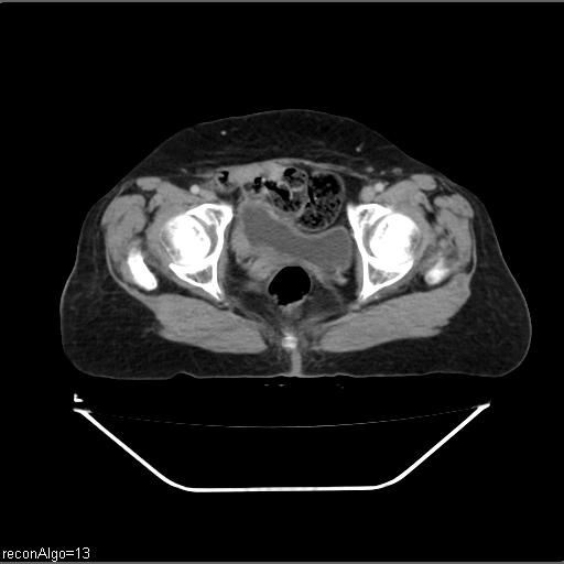 Carcinoma cervix- recurrence (Radiopaedia 34702-36137 B 49).jpg