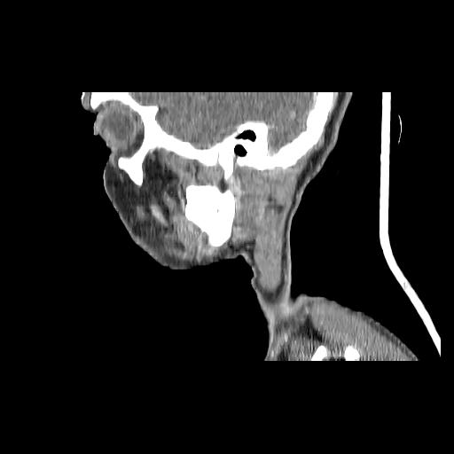 Carcinoma of the maxillary antrum (Radiopaedia 53805-59888 Sagittal C+ delayed 147).jpg
