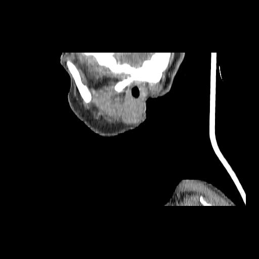 Carcinoma of the maxillary antrum (Radiopaedia 53805-59888 Sagittal C+ delayed 164).jpg