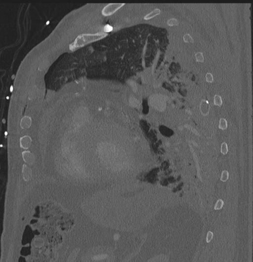Cardiac trauma (Radiopaedia 32874-33858 Sagittal bone window 4).jpg