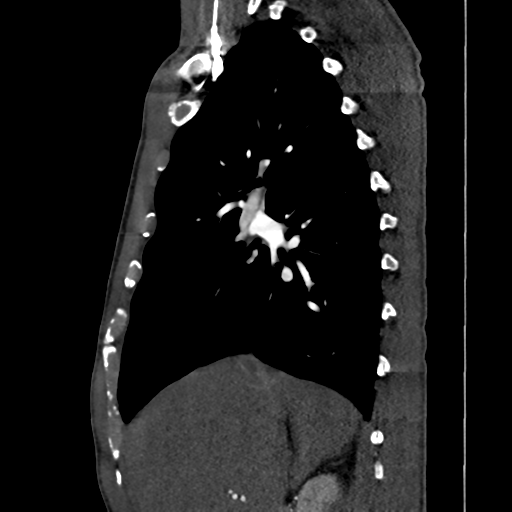 Cardiac tumor - undifferentiated pleomorphic sarcoma (Radiopaedia 45844-50134 B 54).png