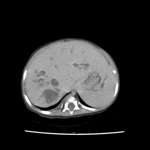 Caroli disease with autosomal recessive polycystic kidney disease (ARPKD) (Radiopaedia 89651-106703 B 38).jpg