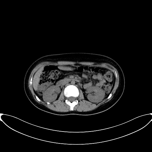 Caroli disease with medullary sponge kidney (Radiopaedia 82622-96804 Axial non-contrast 30).jpg